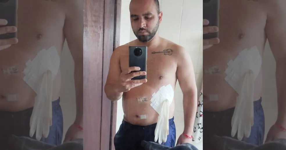 Médico coloca luva cirúrgica em vez de bolsa de colostomia em paciente