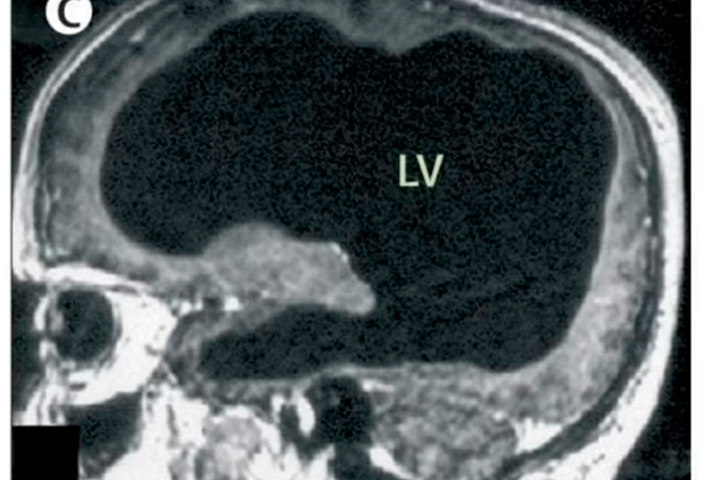 Homem descobre aos 44 anos que vive com cérebro oco